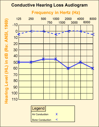 Conductive Hearing Loss Audiogram