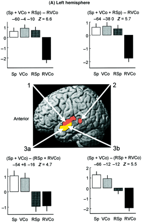 Scott et al Brain (2000) figure 2